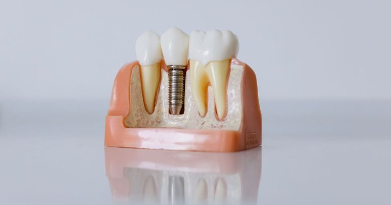 Dental implant model showing the implant post set in the jawbone between natural teeth