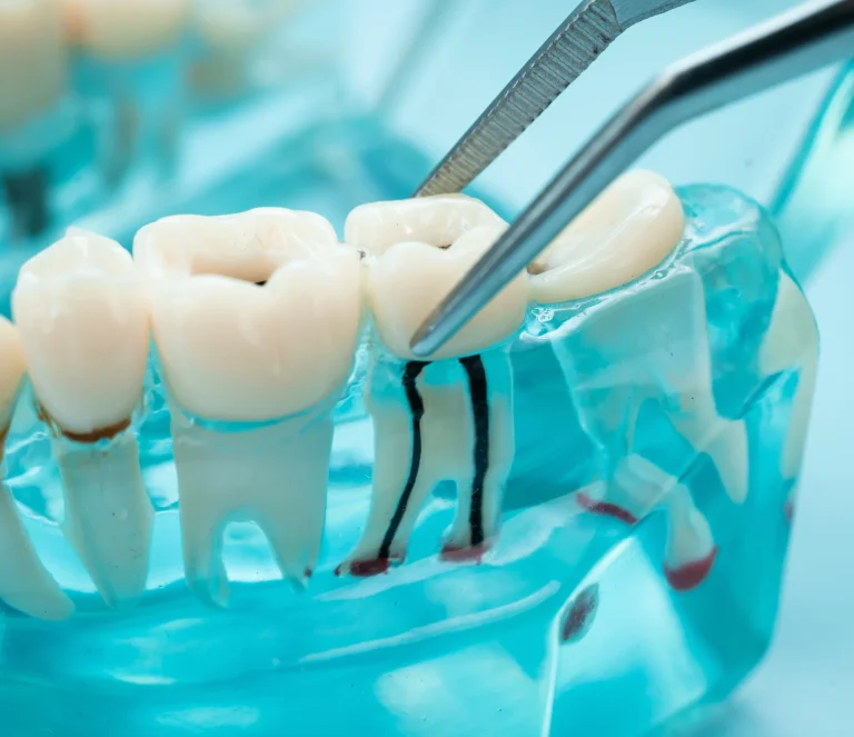 Tooth model showing the canals inside each root